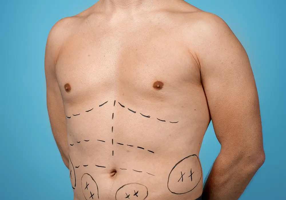 lipofilling-homme lipofilling-homme